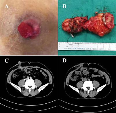 Robot-Assisted Totally Intracorporeal Resection of Cutaneous Ureterostomy Tumor and Ileal Conduit Surgery: A Rare Case Report